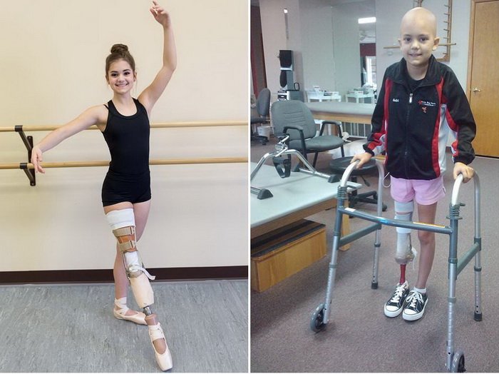 Балерина без ноги: как 15-летняя девушка победила рак на пути к своей мечте
